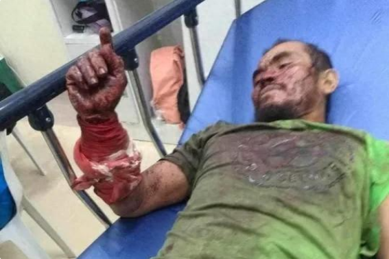 菲律宾一名男子在遭到蟒蛇咬后咬回并杀死了它